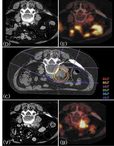 Common iliac lymph node recurrence with cervical cancer. (A) Enhanced... | Download Scientific ...