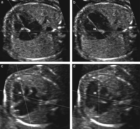 Fetal Cardiac Axis Normal Range - PELAJARAN