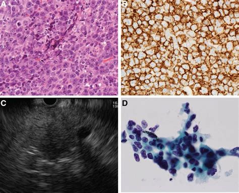 A cervical lymph node biopsy was conducted, and diffuse large B-cell ...