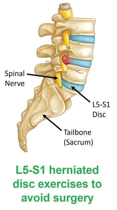 Herniated disc treatment L5-S1 with 3 exercises to avoid surgery