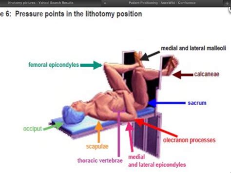 Compartment Syndrome Lithotomy Position at Margaret May blog