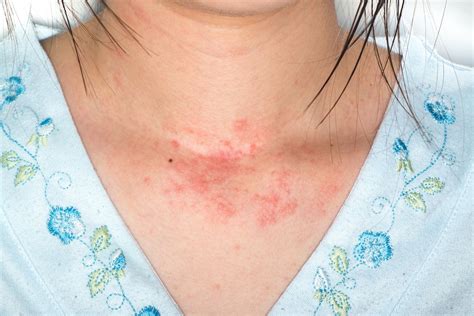 Skin Allergy: Identifying 3 Common Skin Rashes