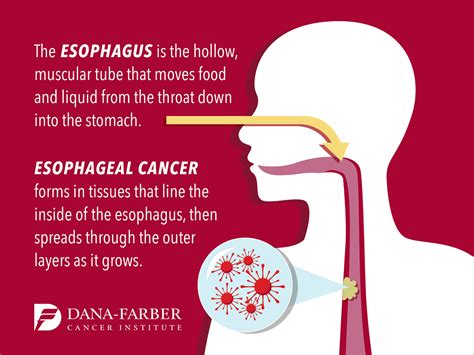 Signs and Symptoms of Esophageal Cancer | Dana-Farber Cancer Institute