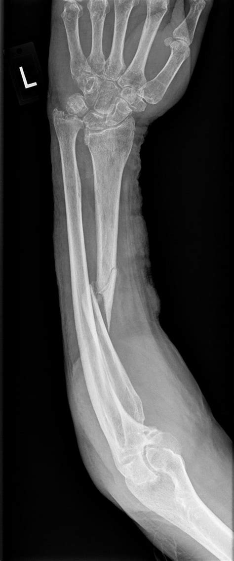 Ao classification of galeazzi fracture - beanmumu