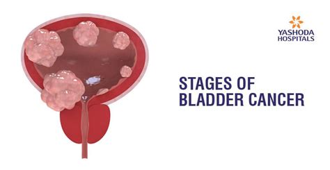 Stages Of Bladder Cancer In Men