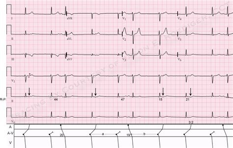 Wenckebach phenomenon | ECG Guru - Instructor Resources