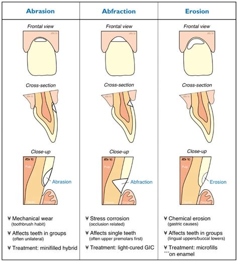 What is the difference between dental attrition, abfraction, erosion and abrasion? | News ...