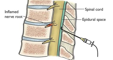 Cervical Epidural Steroid Injection - Life After and What to Know