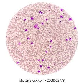 Chronic Myelogenous Leukemia Cml Known Chronic Stock Photo 2208522779 | Shutterstock