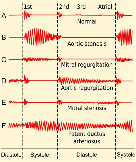 Overview of Heart Murmurs - almostadoctor