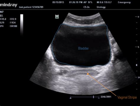 Ultrasound Leadership Academy: The Basics of Pelvic Transabdominal Ultrasound — EM Curious