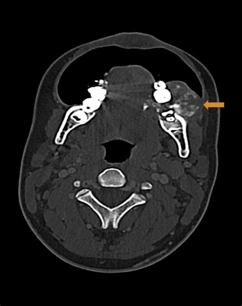 -CT neck shows soft tissue mass lesion, with heterogeneous osteoid ...