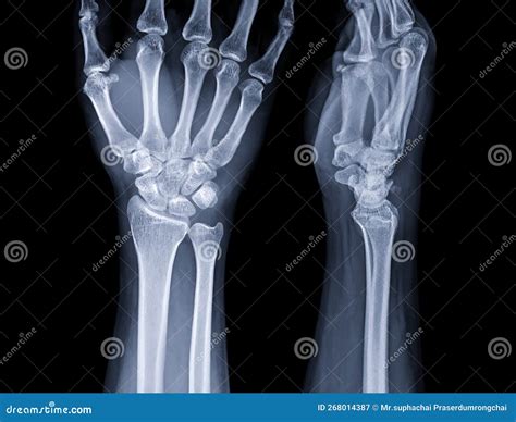 X-ray Image of Wrist Joint for Diagnosis Rheumatoid Arthritis Stock Image - Image of imaging ...