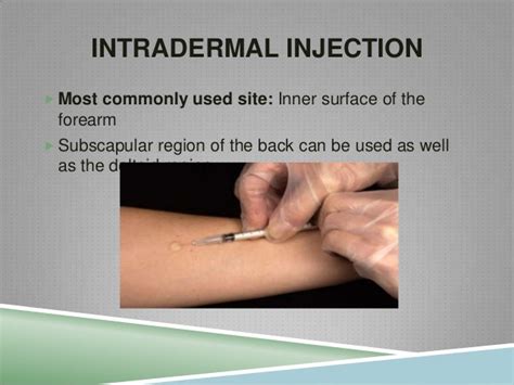 Intradermal Injection Technique