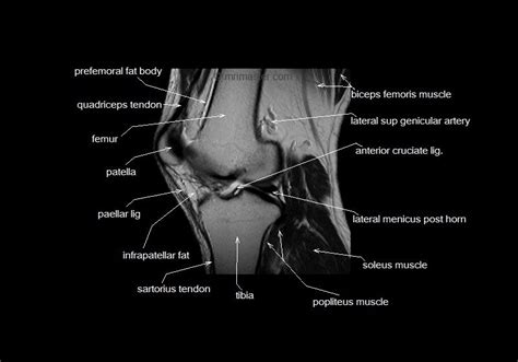 mri knee cross sectional anatomy sagittal image 8 | Mri, Knee mri ...