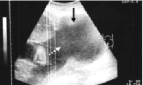 Ultrasound image showing the amniotic sac protruding out from the Kerr ...