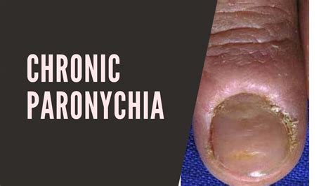 Chronic Paronychia: Causes, Symptoms, Treatment, And Prevention » 2023