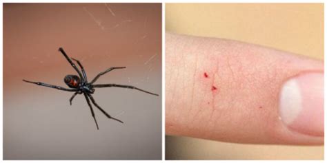 What To Do After A Black Widow Bite - How to Remove a Tick Head Stuck in Your Skin - Mom Goes ...