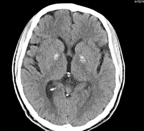 Cureus | The Anterior Globus Pallidus Externus of Basal Ganglia as ...