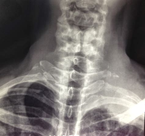 VIETNAMESE MEDIC ULTRASOUND: CASE 224: LEFT SUPRACLAVICULAR MASS, Dr PHAN THANH HẢI, MEDIC ...