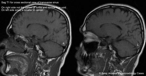 Dr Balaji Anvekar FRCR: Hypoplastic transverse sinus MRI