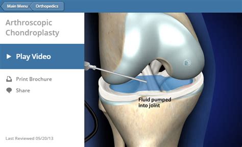 Arthroscopic Knee Surgery NYC | Manhattan Orthopedic Care