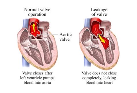 aortic valve replacement recovery stories - gustavejung