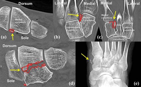 Categorization of single cuneiform fractures and investigation of related injuries: A 10-year ...