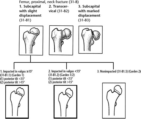 OTA/AO classification of femoral neck fractures. | Download Scientific ...