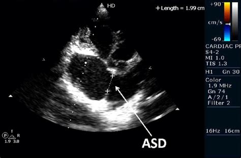 Transesophageal echocardiography confirmed the diagnosis of ostium ...