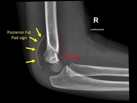 Supracondylar Fracture Fat Pad Sign