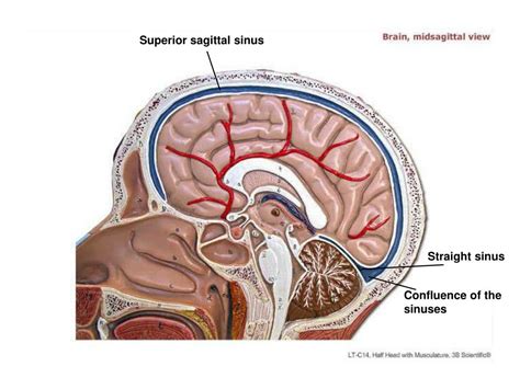 Straight Sinus