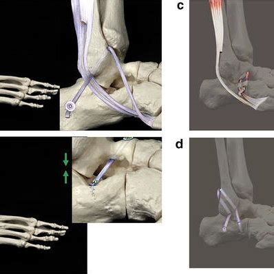 a Combined ankle instability and subtalar joint osteoarthritis with ...