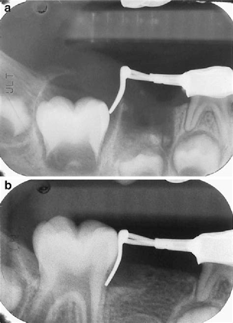 Optimal fit of chairside-fabricated distal shoe space maintainer | Semantic Scholar