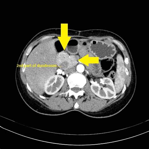 annular pancreas - Αναζήτηση Google | Radiology, Pancreas, Pet ct