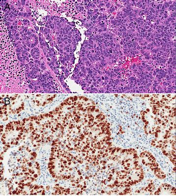 Large cell neuroendocrine carcinoma. A.H&E, 20x magnification, large ...