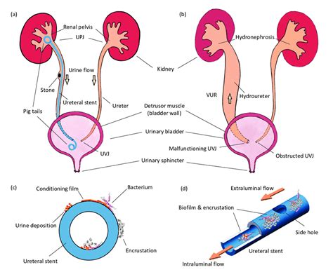 Ureterovesical Junction Obstructive Nephropathy, 56% OFF