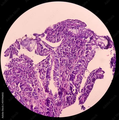 Terminal ileum(biopsy): Chronic nonspecific ileitis or inflammation of ileum, show ileal mucosa ...