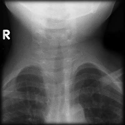 ON - RADIOLOGY: Croup (acute laryngotracheobronchitis) on X-ray with steeple sign