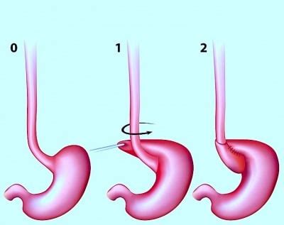 Hernia de hiato o hiatal, por deslizamento, que es, síntomas y tratamiento