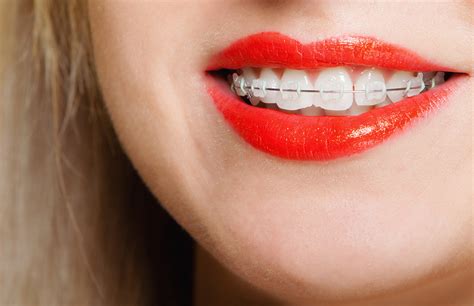 Clear Braces | Ceramic Braces | Melissa Dentist | Dentist Texas