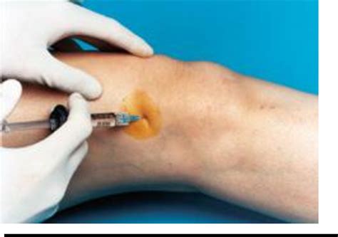 Figure 2 from Intra-articular hyaluronic acid injections for knee osteoarthritis. | Semantic Scholar