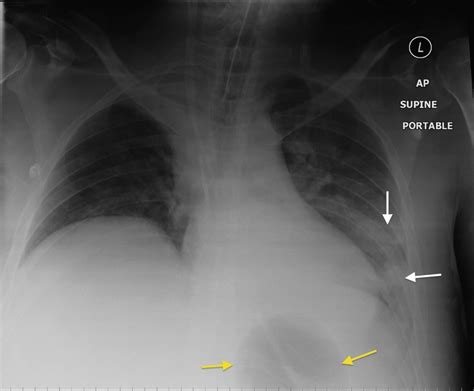 Sengstaken-Blakemore Tube - Radiology at St. Vincent's University Hospital