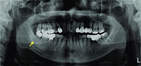 Panoramic radiograph showing an apical radiolucency associated with the... | Download Scientific ...