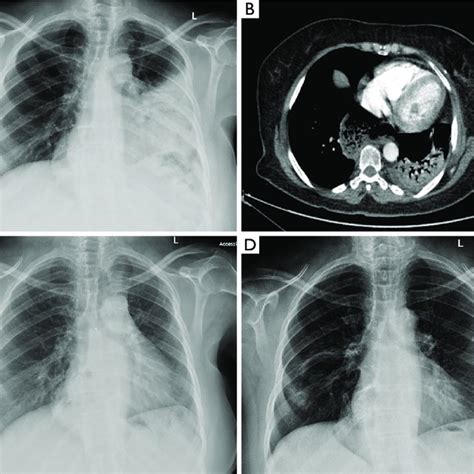 CT guided H&E lung biopsy ×100 magnification showing cores of lung... | Download Scientific Diagram