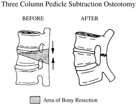 Pedicle Subtraction Osteotomy for the Treatment of Fixed Sag... : JBJS