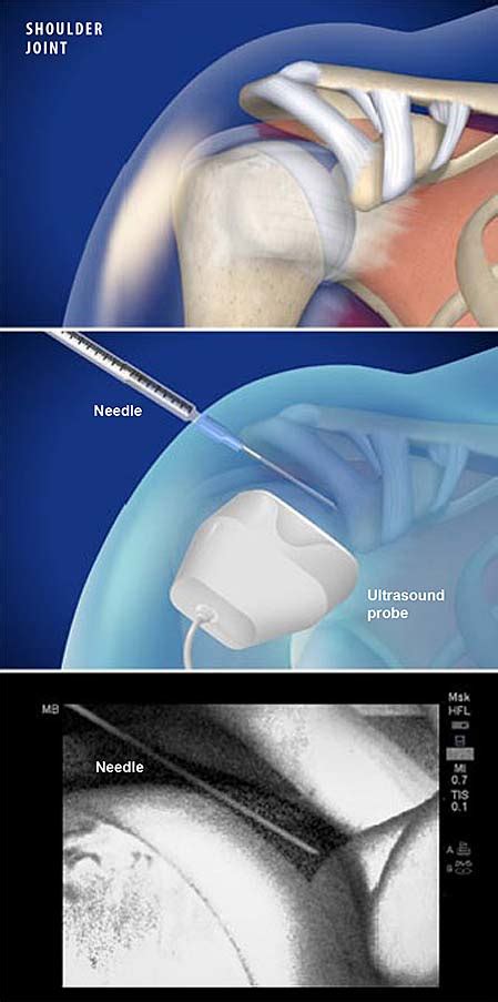 Ultrasound-Guided Injection for Shoulder Pain | Central Coast Orthopedic Medical Group