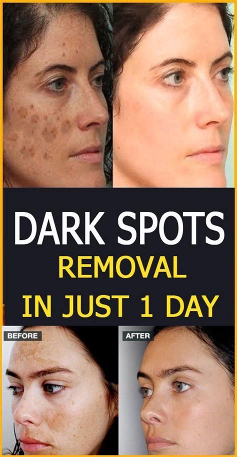 Dark spots removal tips | Brown spots on face, Dark spots on skin ...