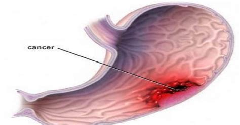 Salud y Más.: Cáncer de estómago una enfermedad silenciosa, Sabes ...