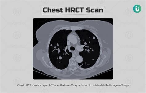 Chest HRCT: Procedure, Purpose, Results, Cost, Price, Online booking